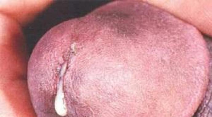Хламидиоз у мужчин: симптомы, схема и курс лечения препаратами, возможные последствия Лекарство для лечения хламидиоза у мужчин
